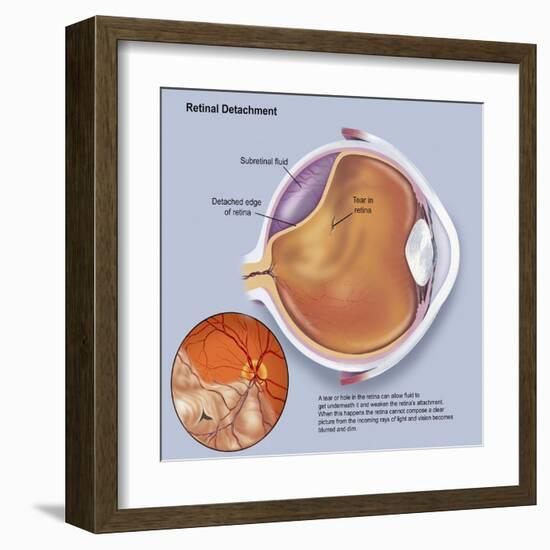 Diagram of a Retinal Detachment-null-Framed Art Print