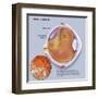 Diagram of a Retinal Detachment-null-Framed Art Print