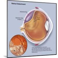 Diagram of a Retinal Detachment-null-Mounted Art Print