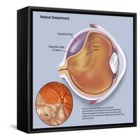 Diagram of a Retinal Detachment-null-Framed Stretched Canvas