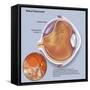 Diagram of a Retinal Detachment-null-Framed Stretched Canvas