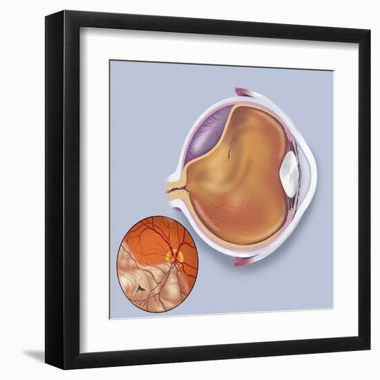 Diagram of a Retinal Detachment-null-Framed Art Print