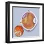 Diagram of a Retinal Detachment-null-Framed Art Print