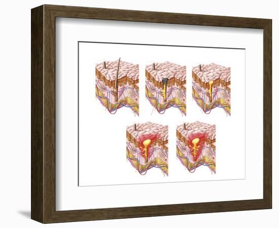Different Types of Acne, Non-Inflammatory and Inflammatory-null-Framed Art Print