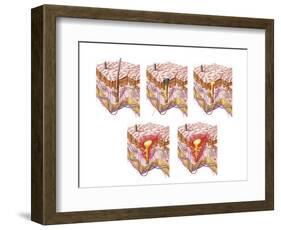 Different Types of Acne, Non-Inflammatory and Inflammatory-null-Framed Art Print