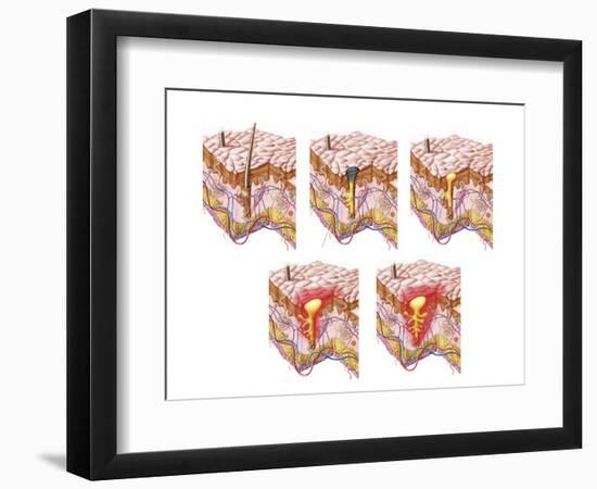 Different Types of Acne, Non-Inflammatory and Inflammatory-null-Framed Art Print