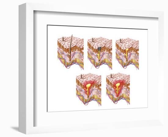 Different Types of Acne, Non-Inflammatory and Inflammatory-null-Framed Art Print