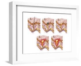 Different Types of Acne, Non-Inflammatory and Inflammatory-null-Framed Art Print