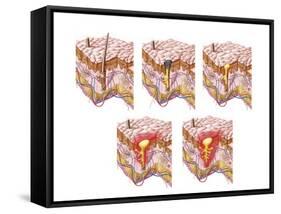 Different Types of Acne, Non-Inflammatory and Inflammatory-null-Framed Stretched Canvas