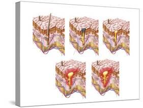 Different Types of Acne, Non-Inflammatory and Inflammatory-null-Stretched Canvas