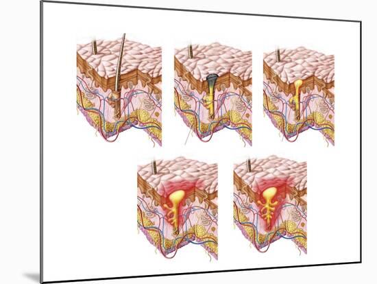 Different Types of Acne, Non-Inflammatory and Inflammatory-null-Mounted Art Print