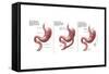 Digestive System: Normal, Gastric Band, Bypass-Gwen Shockey-Framed Stretched Canvas