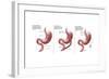 Digestive System: Normal, Gastric Band, Bypass-Gwen Shockey-Framed Art Print