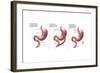 Digestive System: Normal, Gastric Band, Bypass-Gwen Shockey-Framed Art Print