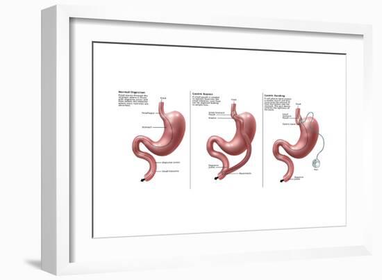 Digestive System: Normal, Gastric Band, Bypass-Gwen Shockey-Framed Art Print