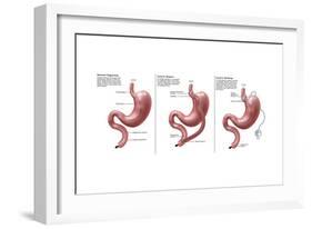 Digestive System: Normal, Gastric Band, Bypass-Gwen Shockey-Framed Art Print