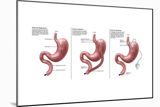 Digestive System: Normal, Gastric Band, Bypass-Gwen Shockey-Mounted Art Print