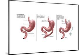 Digestive System: Normal, Gastric Band, Bypass-Gwen Shockey-Mounted Art Print