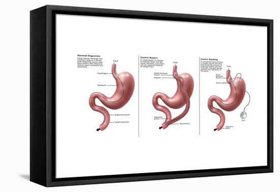 Digestive System: Normal, Gastric Band, Bypass-Gwen Shockey-Framed Stretched Canvas