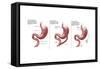 Digestive System: Normal, Gastric Band, Bypass-Gwen Shockey-Framed Stretched Canvas