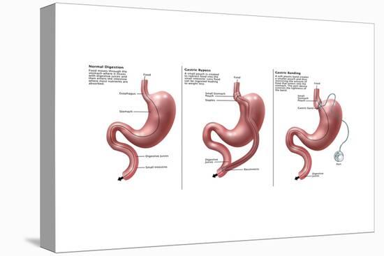 Digestive System: Normal, Gastric Band, Bypass-Gwen Shockey-Stretched Canvas