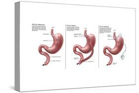 Digestive System: Normal, Gastric Band, Bypass-Gwen Shockey-Stretched Canvas