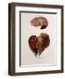 Diseased Livers, Hepatitis, Illustration, 1897-Science Source-Framed Giclee Print