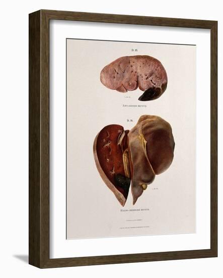 Diseased Livers, Hepatitis, Illustration, 1897-Science Source-Framed Giclee Print