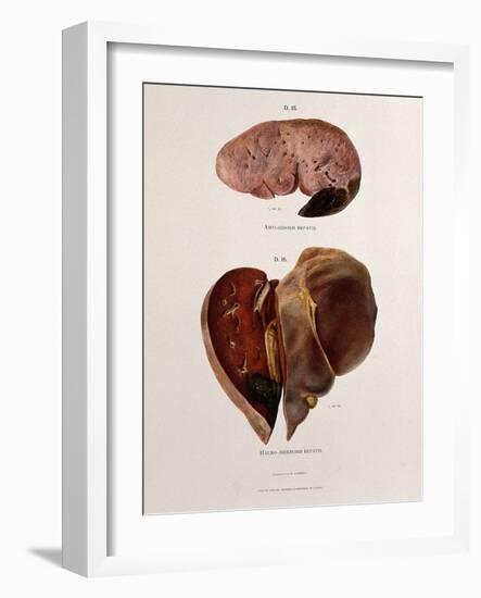 Diseased Livers, Hepatitis, Illustration, 1897-Science Source-Framed Giclee Print