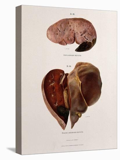 Diseased Livers, Hepatitis, Illustration, 1897-Science Source-Stretched Canvas