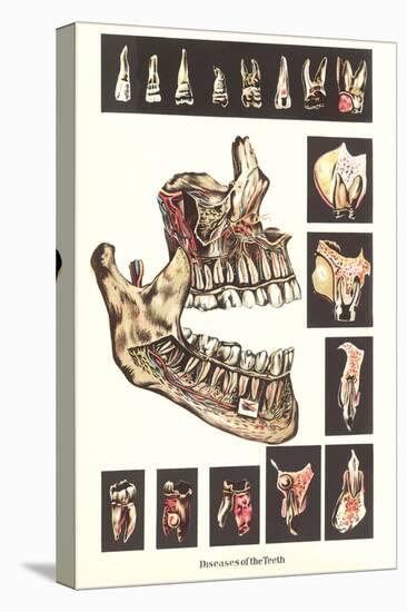 Diseases of the Teeth-null-Stretched Canvas