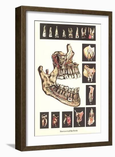 Diseases of the Teeth-null-Framed Art Print