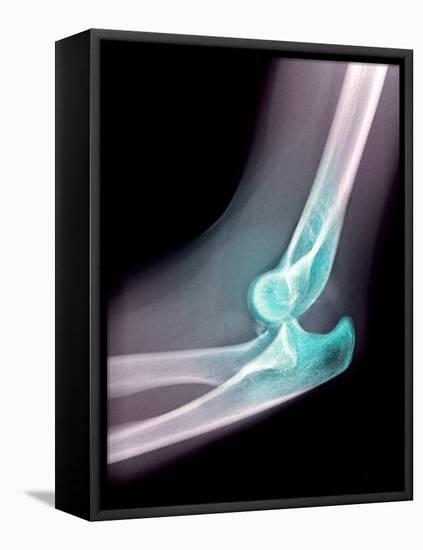 Dislocated Elbow, X-ray-Du Cane Medical-Framed Stretched Canvas