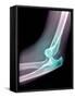 Dislocated Elbow, X-ray-Du Cane Medical-Framed Stretched Canvas