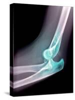 Dislocated Elbow, X-ray-Du Cane Medical-Stretched Canvas
