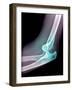 Dislocated Elbow, X-ray-Du Cane Medical-Framed Photographic Print