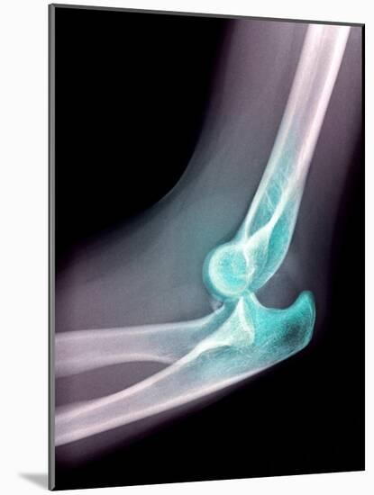 Dislocated Elbow, X-ray-Du Cane Medical-Mounted Photographic Print