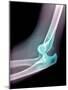 Dislocated Elbow, X-ray-Du Cane Medical-Mounted Photographic Print