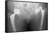 Dislocated Hip Replacement, X-ray-Du Cane Medical-Framed Stretched Canvas