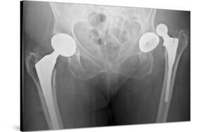 Dislocated Hip Replacement, X-ray-Du Cane Medical-Stretched Canvas