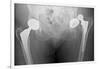 Dislocated Hip Replacement, X-ray-Du Cane Medical-Framed Photographic Print