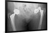 Dislocated Hip Replacement, X-ray-Du Cane Medical-Framed Photographic Print