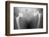 Dislocated Hip Replacement, X-ray-Du Cane Medical-Framed Photographic Print