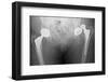 Dislocated Hip Replacement, X-ray-Du Cane Medical-Framed Photographic Print