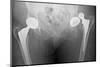 Dislocated Hip Replacement, X-ray-Du Cane Medical-Mounted Photographic Print