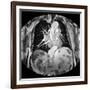 Dissecting Aorta, MRI Scan-Du Cane Medical-Framed Photographic Print