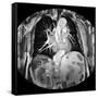 Dissecting Aorta, MRI Scan-Du Cane Medical-Framed Stretched Canvas