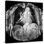 Dissecting Aorta, MRI Scan-Du Cane Medical-Stretched Canvas
