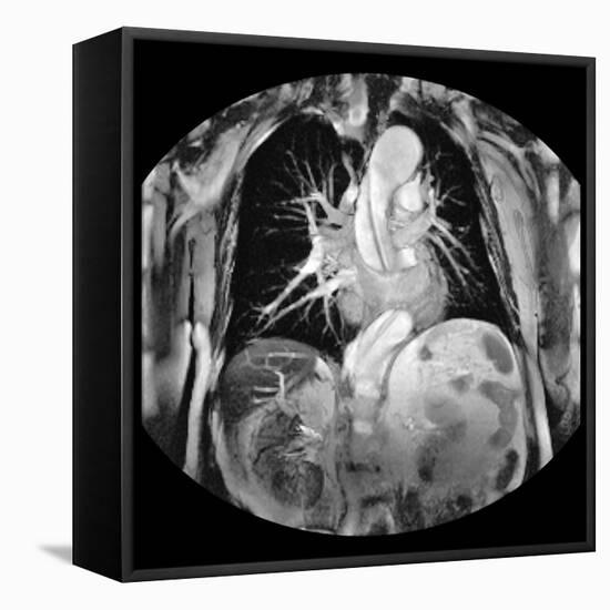 Dissecting Aorta, MRI Scan-Du Cane Medical-Framed Stretched Canvas