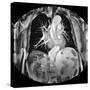 Dissecting Aorta, MRI Scan-Du Cane Medical-Stretched Canvas